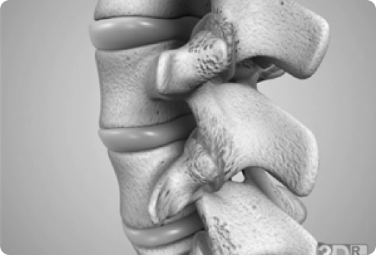 Arthritis / Degenerative Joint Disease (DJD) - Joint Surface