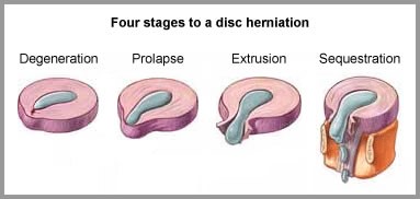 Disc Degeneration - Fours Stages to a disc herniation