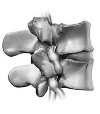 Three-dimensional lumbar vertebrae highlighting the structure of the spinal bones - Dublin Physio
