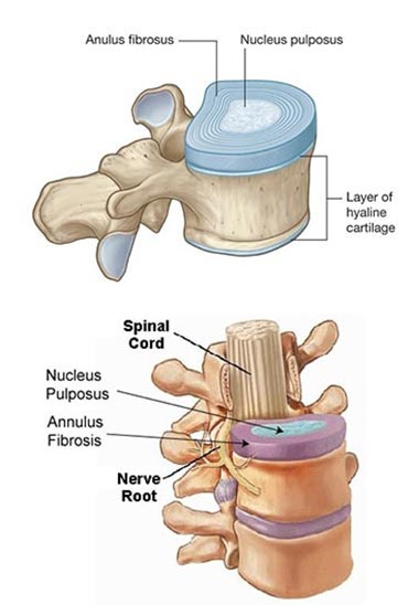 Disc Degeneration - Spinal Cord